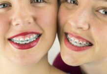 Современные брекет системы