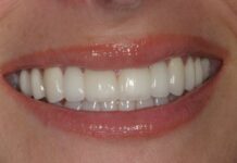 Почему циркониевые коронки считают эталоном