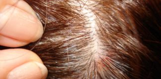 Прыщи на голове: откуда они берутся и как от них избавиться