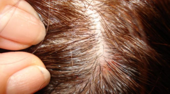 Прыщи на голове: откуда они берутся и как от них избавиться