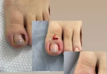 Всё о вросшем ногте: причины, симптомы, лечение и профилактика