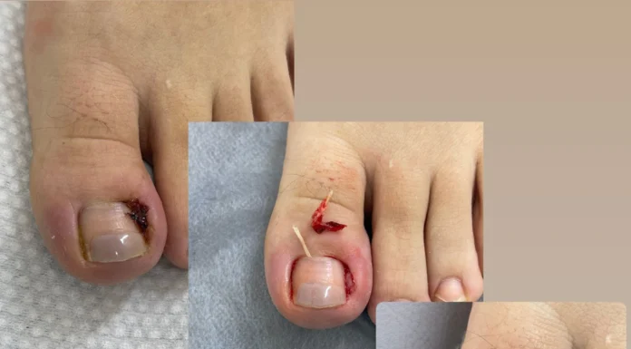 Всё о вросшем ногте: причины, симптомы, лечение и профилактика