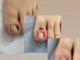 Всё о вросшем ногте: причины, симптомы, лечение и профилактика